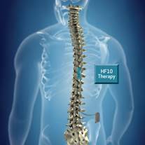 What You Need to Know About Nevro HF10 Spinal Cord Stimulation