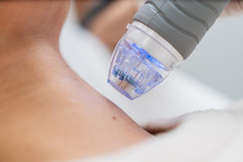 RF Microneedling: The All-Natural Treatment for a More Youthful Complexion