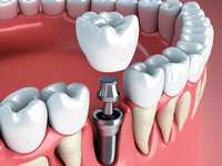 Assessing Eligibility for Dental Implants From a Periodontist’s Perspective