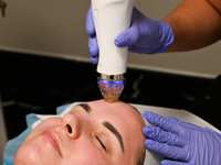 Boost Your Collagen: The Benefits of Microneedling