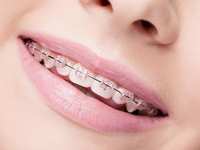 How Long Do Braces Take?